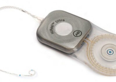 Implante Cochlear HiRes Cochlear
