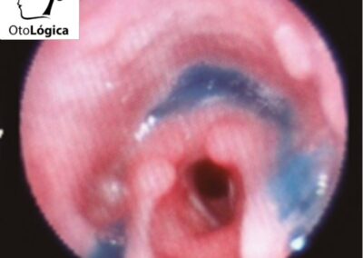 Estudio fibroendoscópico de la deglución (FEES)