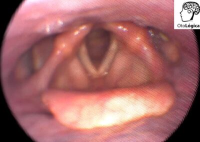 Endoscopía de laringe