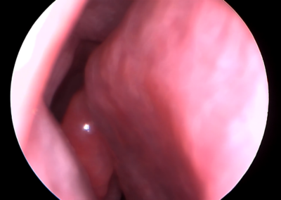 Endoscopía de nariz