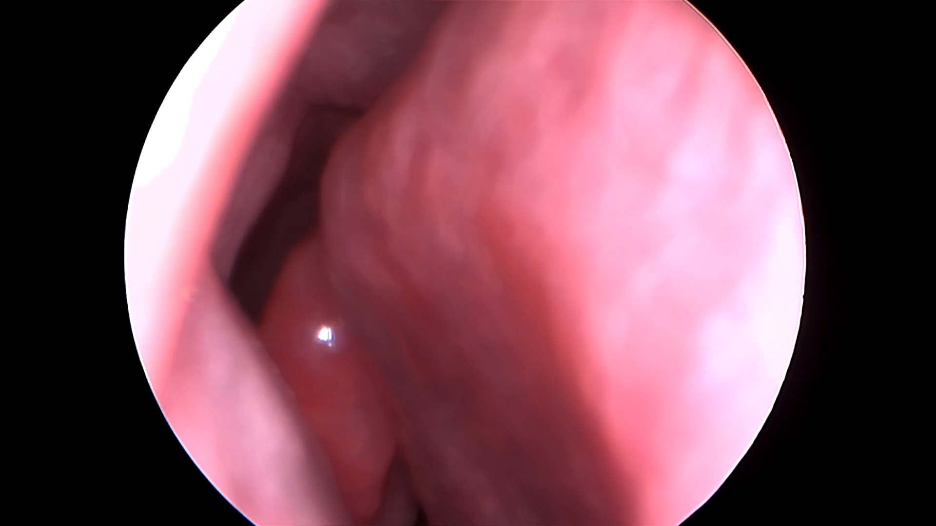 Endoscopía de cavidad nasal.