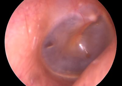 Endoscopía de oído